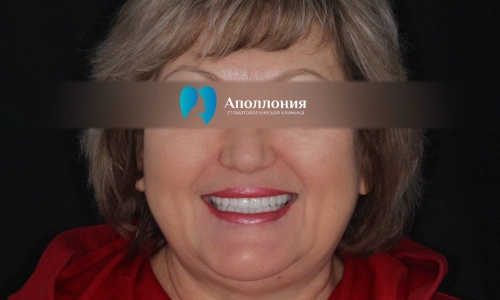 Имплантация + протезирование до