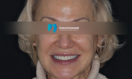 Имплантация + протезирование до