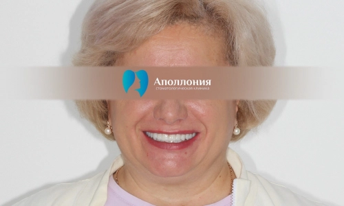 Имплантация + протезирование до