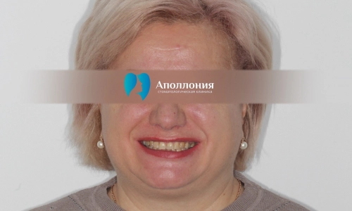 Имплантация + протезирование до